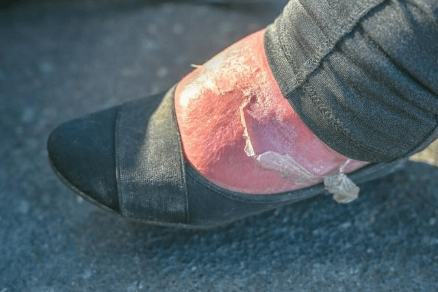 Homeles Womans Blisted Foot